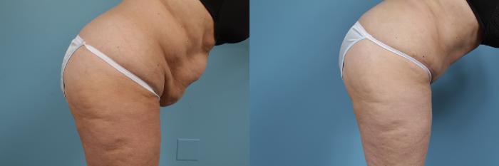Before & After Tummy Tuck by Dr. Mustoe Case 355 View #4 View in Chicago, IL
