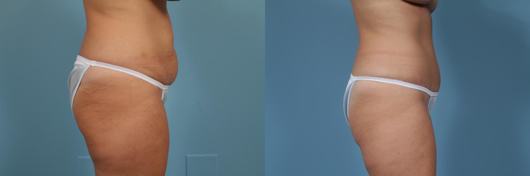 Before & After Tummy Tuck by Dr. Mustoe Case 364 View #3 View in Chicago, IL