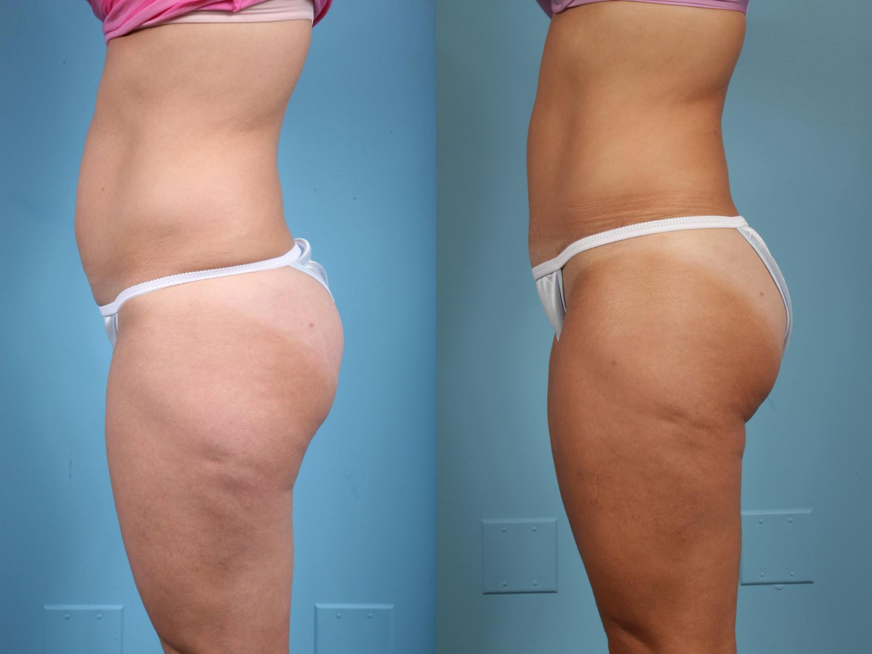 Before & After Tummy Tuck by Dr. Mustoe Case 39 View #2 View in Chicago, IL