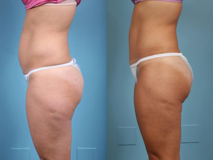 Before & After Tummy Tuck by Dr. Mustoe Case 39 View #2 View in Chicago, IL