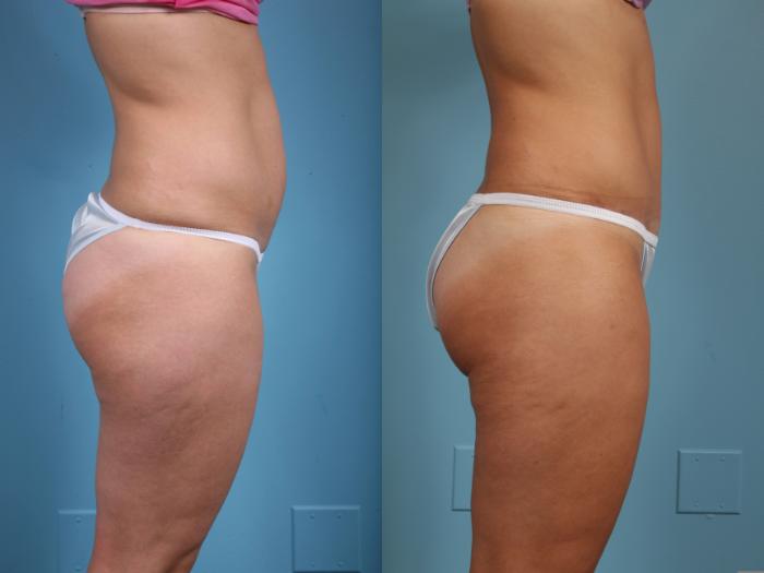 Before & After Tummy Tuck by Dr. Mustoe Case 39 View #3 View in Chicago, IL