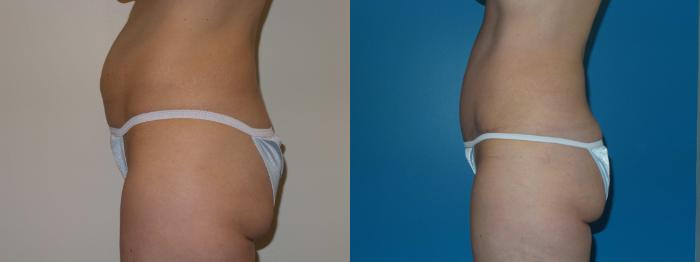 Before & After Tummy Tuck by Dr. Mustoe Case 399 View #1 View in Chicago, IL