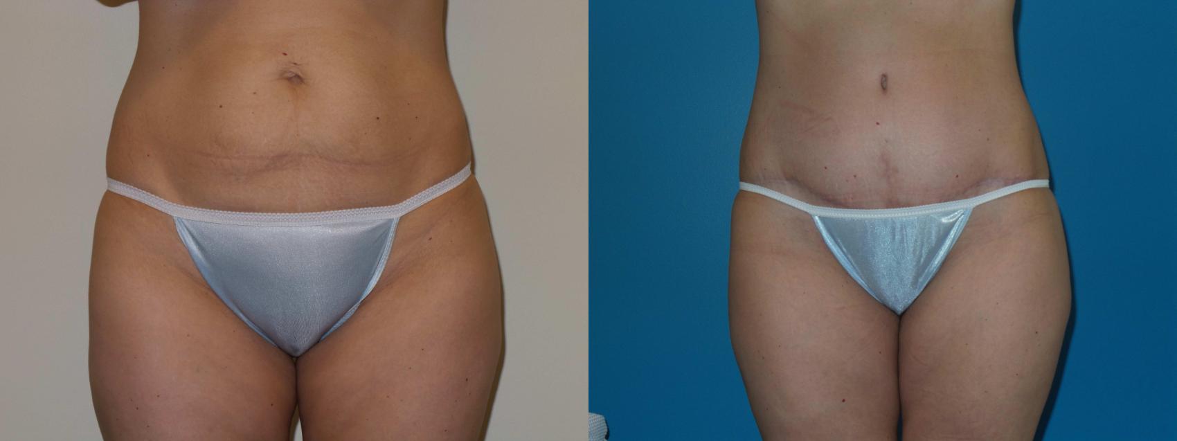 Before & After Tummy Tuck by Dr. Mustoe Case 399 View #2 View in Chicago, IL