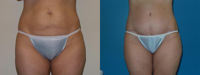 Before & After Tummy Tuck by Dr. Mustoe Case 399 View #2 View in Chicago, IL