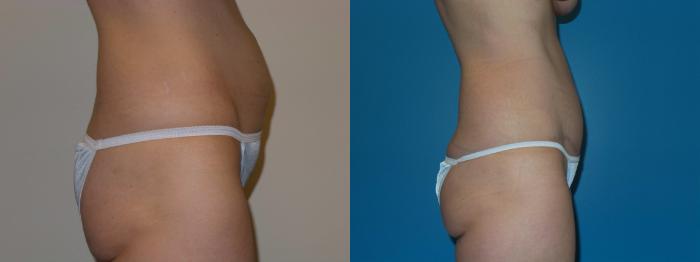 Before & After Tummy Tuck by Dr. Mustoe Case 399 View #3 View in Chicago, IL