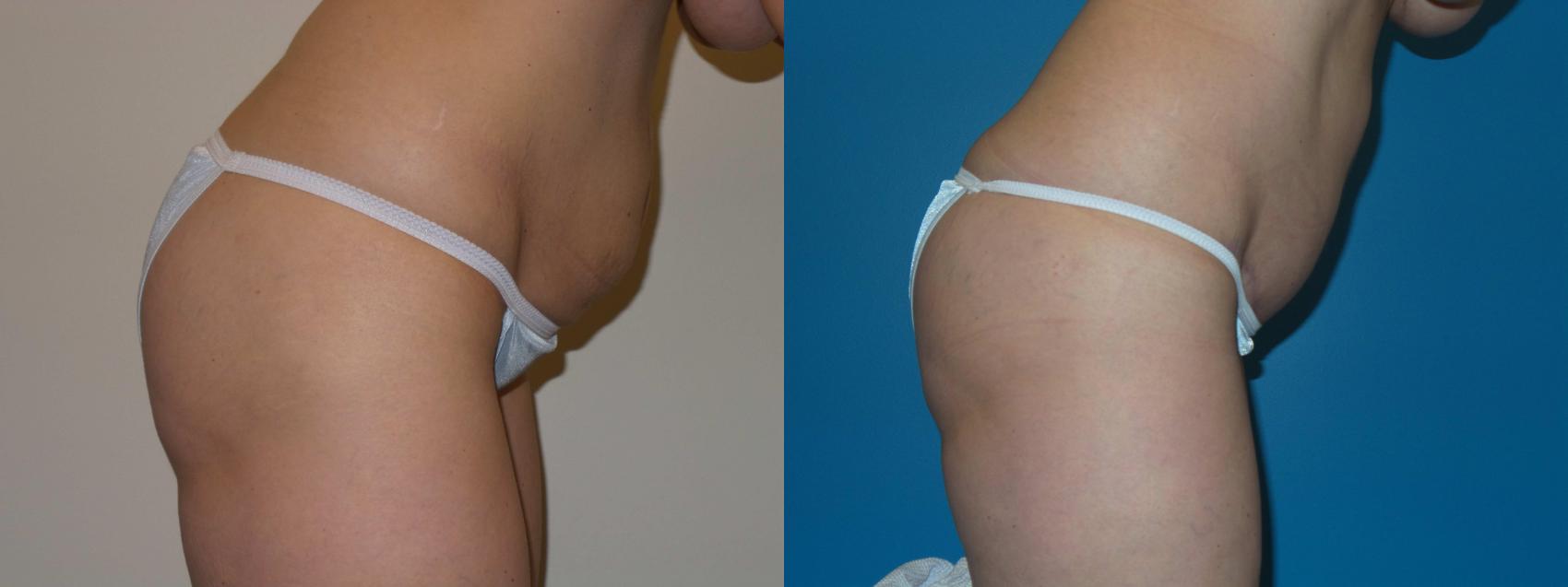 Before & After Tummy Tuck by Dr. Mustoe Case 399 View #4 View in Chicago, IL