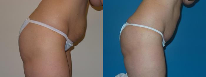 Before & After Tummy Tuck by Dr. Mustoe Case 399 View #4 View in Chicago, IL