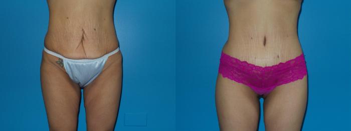 Before & After Tummy Tuck by Dr. Mustoe Case 410 View #1 View in Chicago, IL