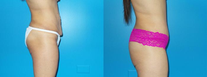 Before & After Tummy Tuck by Dr. Mustoe Case 410 View #3 View in Chicago, IL