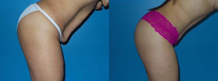 Before & After Tummy Tuck by Dr. Mustoe Case 410 View #4 View in Chicago, IL