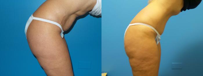 Before & After Tummy Tuck by Dr. Mustoe Case 421 View #3 View in Chicago, IL