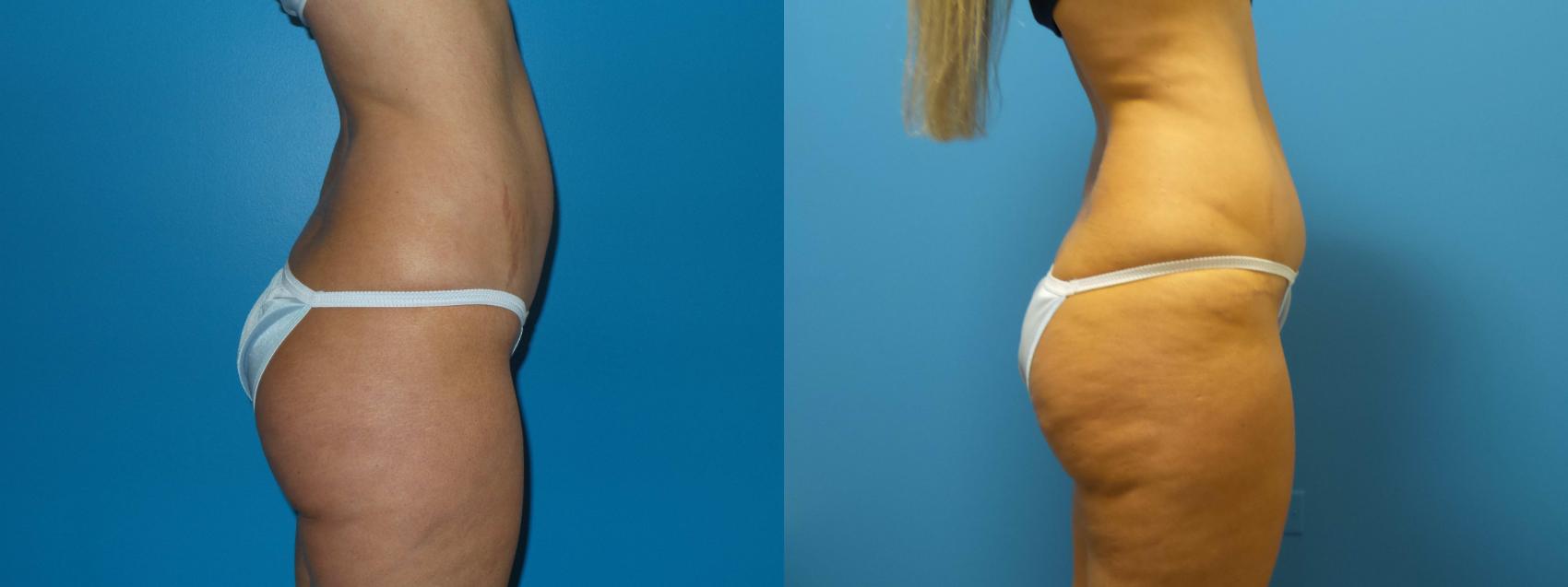 Before & After Tummy Tuck by Dr. Mustoe Case 421 View #4 View in Chicago, IL