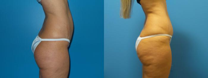 Before & After Tummy Tuck by Dr. Mustoe Case 421 View #4 View in Chicago, IL