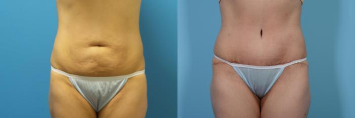 Before & After Tummy Tuck by Dr. Mustoe Case 436 View #1 View in Chicago, IL