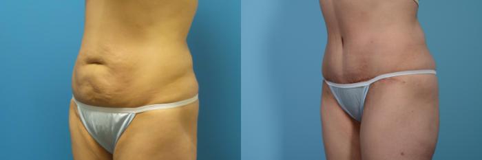 Before & After Tummy Tuck by Dr. Mustoe Case 436 View #2 View in Chicago, IL