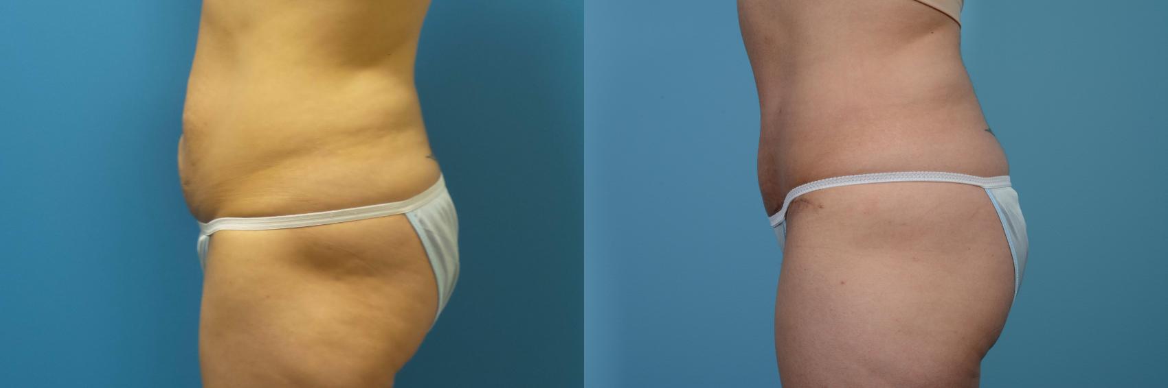 Before & After Tummy Tuck by Dr. Mustoe Case 436 View #3 View in Chicago, IL