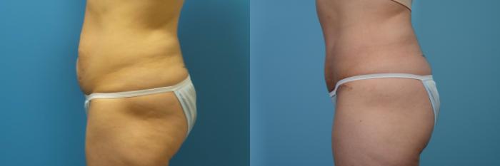 Before & After Tummy Tuck by Dr. Mustoe Case 436 View #3 View in Chicago, IL