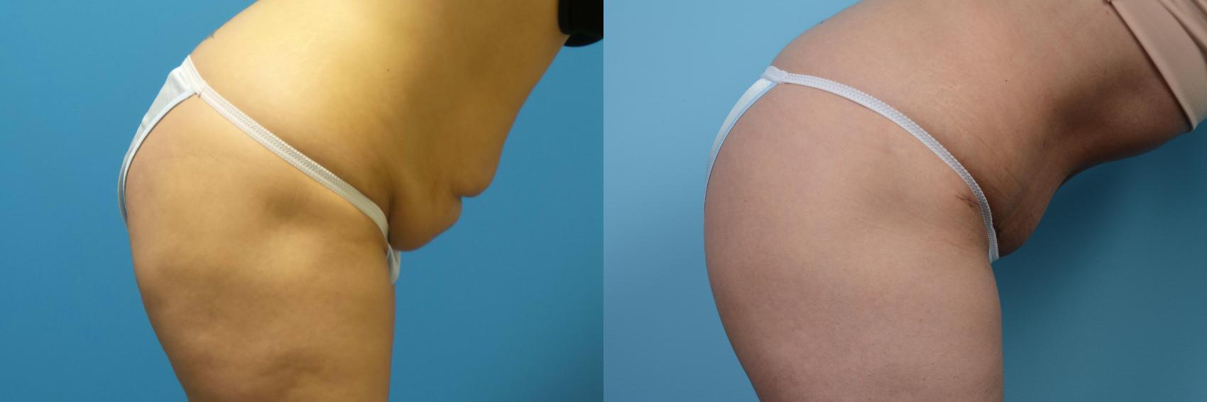 Before & After Tummy Tuck by Dr. Mustoe Case 436 View #4 View in Chicago, IL