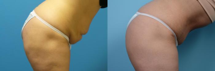 Before & After Tummy Tuck by Dr. Mustoe Case 436 View #4 View in Chicago, IL