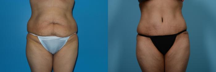 Before & After Tummy Tuck by Dr. Mustoe Case 462 View #1 View in Chicago, IL