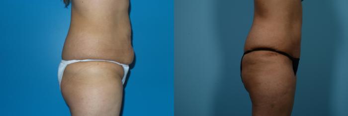 Before & After Tummy Tuck by Dr. Mustoe Case 462 View #3 View in Chicago, IL