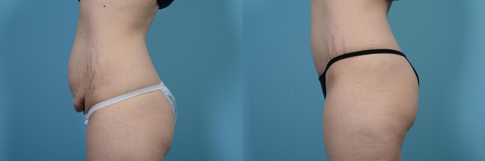 Before & After Tummy Tuck by Dr. Mustoe Case 471 View #2 View in Chicago, IL