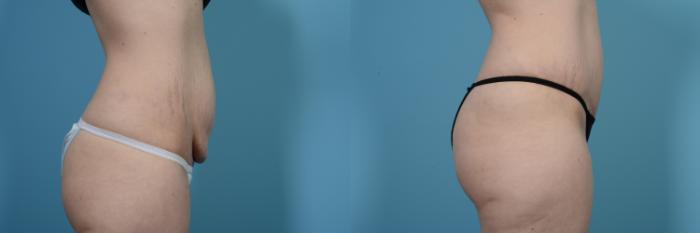 Before & After Tummy Tuck by Dr. Mustoe Case 471 View #3 View in Chicago, IL