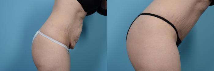Before & After Tummy Tuck by Dr. Mustoe Case 471 View #4 View in Chicago, IL