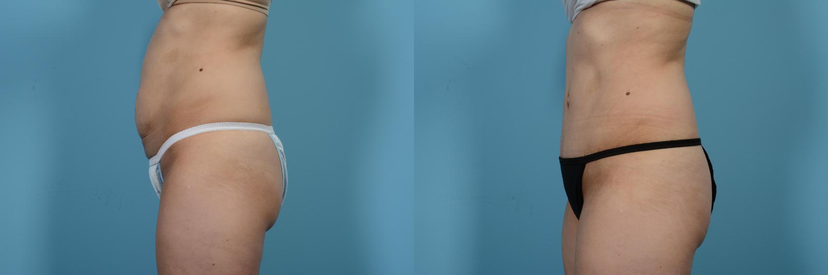 Before & After Tummy Tuck by Dr. Mustoe Case 479 View #2 View in Chicago, IL