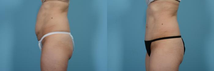 Before & After Tummy Tuck by Dr. Mustoe Case 479 View #2 View in Chicago, IL