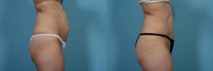 Before & After Tummy Tuck by Dr. Mustoe Case 479 View #3 View in Chicago, IL