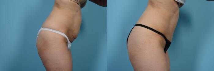Before & After Tummy Tuck by Dr. Mustoe Case 479 View #4 View in Chicago, IL