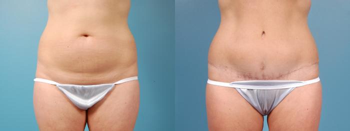 Before & After Tummy Tuck by Dr. Mustoe Case 5 View #1 View in Chicago, IL