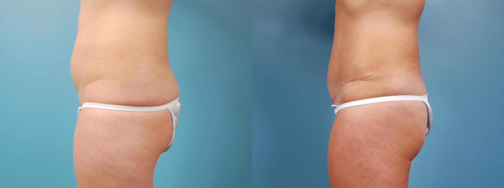 Before & After Tummy Tuck by Dr. Mustoe Case 5 View #2 View in Chicago, IL