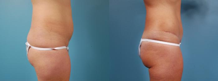 Before & After Tummy Tuck by Dr. Mustoe Case 5 View #3 View in Chicago, IL