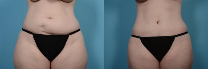 Before & After Tummy Tuck by Dr. Mustoe Case 504 View #1 View in Chicago, IL