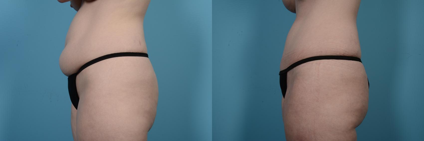 Before & After Tummy Tuck by Dr. Mustoe Case 504 View #2 View in Chicago, IL