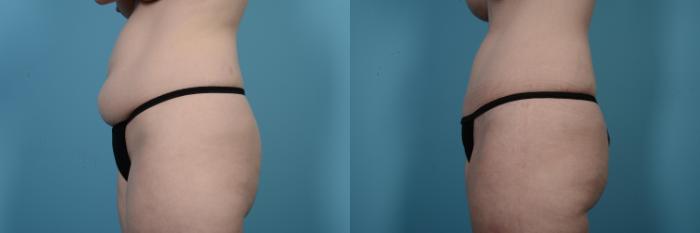 Before & After Tummy Tuck by Dr. Mustoe Case 504 View #2 View in Chicago, IL