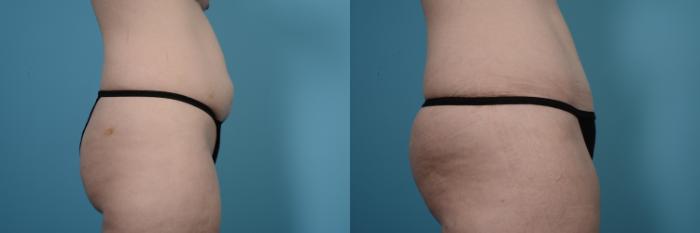 Before & After Tummy Tuck by Dr. Mustoe Case 504 View #3 View in Chicago, IL