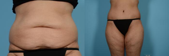 Before & After Tummy Tuck by Dr. Mustoe Case 519 View #1 View in Chicago, IL