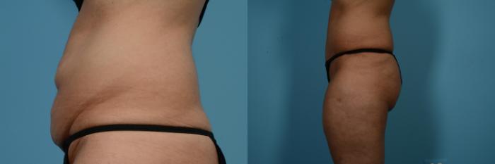 Before & After Tummy Tuck by Dr. Mustoe Case 519 View #2 View in Chicago, IL