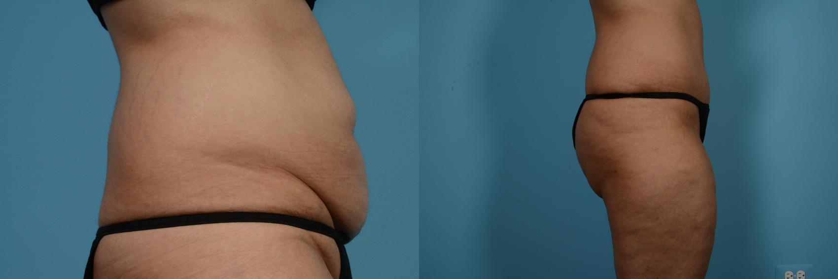 Before & After Tummy Tuck by Dr. Mustoe Case 519 View #3 View in Chicago, IL