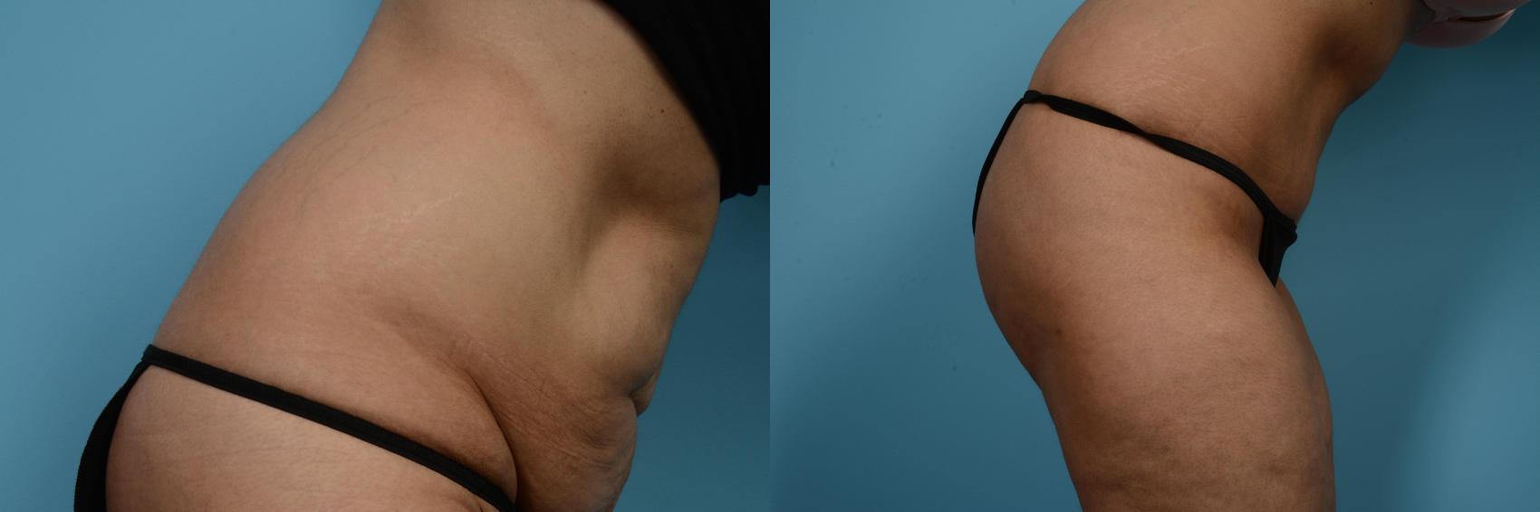 Before & After Tummy Tuck by Dr. Mustoe Case 519 View #4 View in Chicago, IL