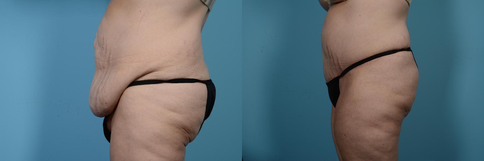 Before & After Tummy Tuck by Dr. Mustoe Case 524 View #2 View in Chicago, IL