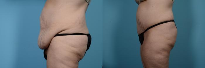 Before & After Tummy Tuck by Dr. Mustoe Case 524 View #2 View in Chicago, IL
