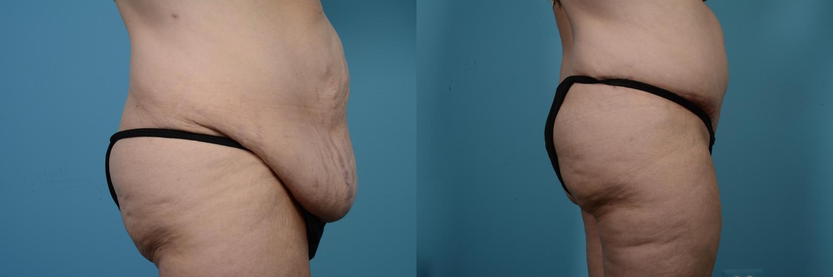 Before & After Tummy Tuck by Dr. Mustoe Case 524 View #3 View in Chicago, IL