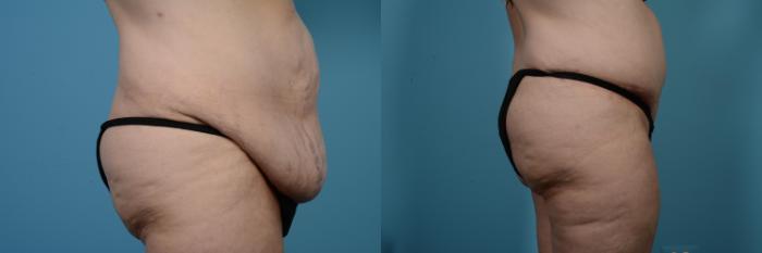 Before & After Tummy Tuck by Dr. Mustoe Case 524 View #3 View in Chicago, IL