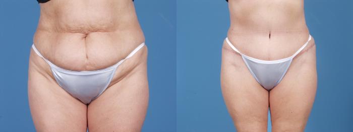 Before & After Tummy Tuck by Dr. Mustoe Case 54 View #1 View in Chicago, IL