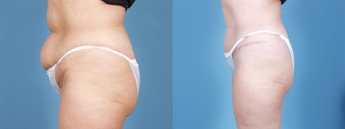 Before & After Tummy Tuck by Dr. Mustoe Case 54 View #2 View in Chicago, IL