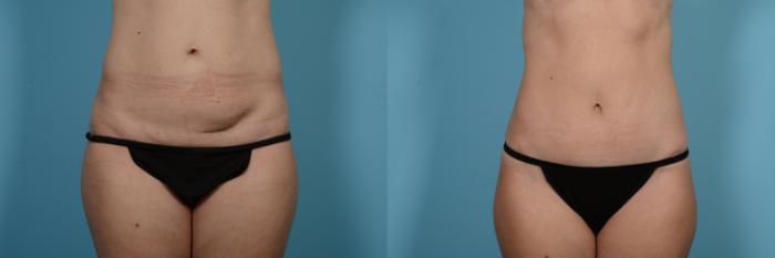 Before & After Tummy Tuck by Dr. Mustoe Case 550 Front View in Chicago, IL